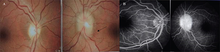 Unilateral Papilledema with Bilateral Optic Nerve Sheath Distension: A Case Report.