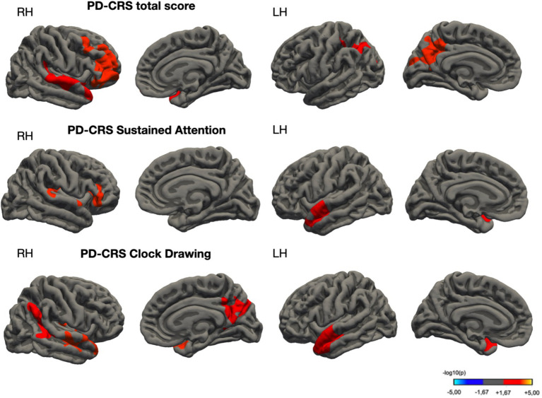 Mapping brain morphology to cognitive deficits: a study on PD-CRS scores in Parkinson's disease with mild cognitive impairment.