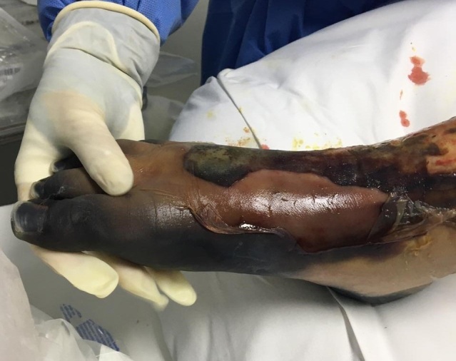 Catastrophic thrombotic events with partial bilateral amputation of legs and fingers in a 12-year-old girl with COVID-19 in Brazil: case report.
