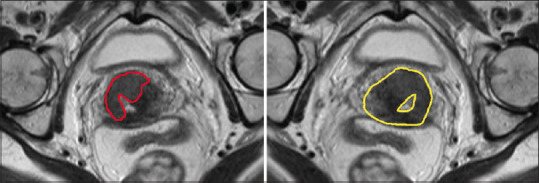 Magnetic Resonance Image Radiomic Reproducibility: The Impact of Preprocessing on Extracted Features from Gross and High-Risk Clinical Tumor Volumes in Cervical Cancer Patients before Brachytherapy.