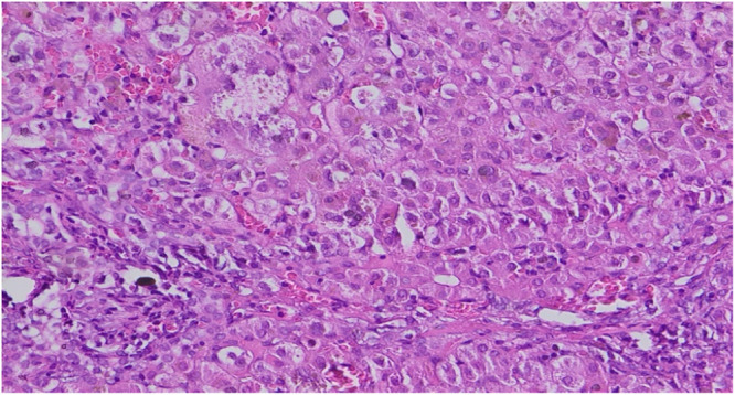 ZFYVE19 gene mutation: A novel variant of progressive familial intrahepatic cholestasis.