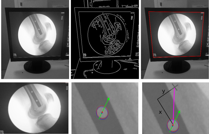 Fast and accurate distal locking of interlocked intramedullary nails using computer-vision and a 3D printed device.