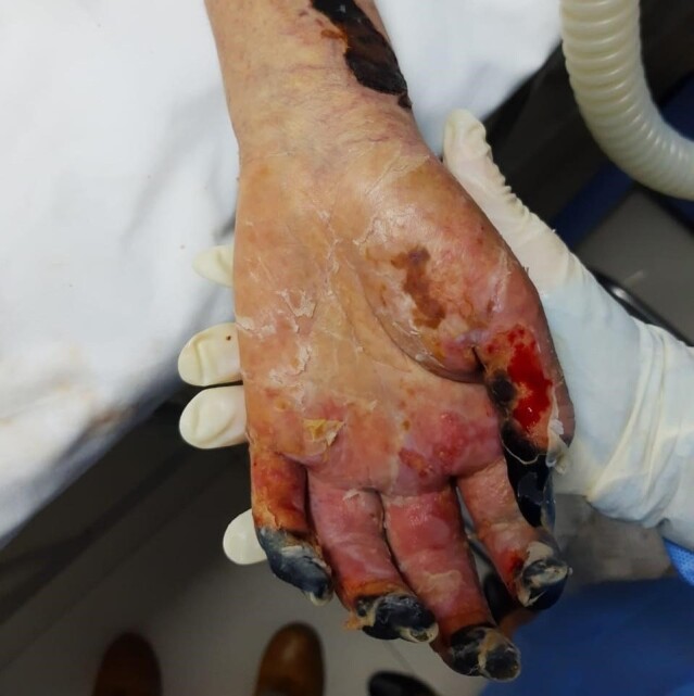 Catastrophic thrombotic events with partial bilateral amputation of legs and fingers in a 12-year-old girl with COVID-19 in Brazil: case report.