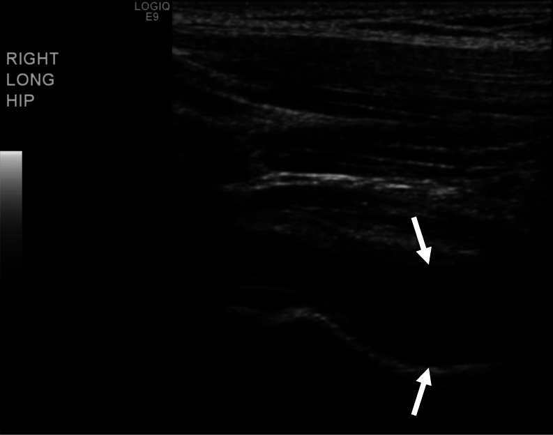 Transient synovitis associated with leuprolide depot (Lupron).