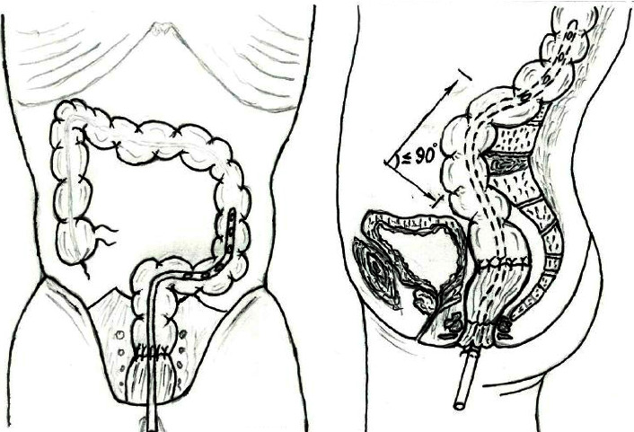 Transanal Intubation for Preventing Colorectal Anastomotic Failure.