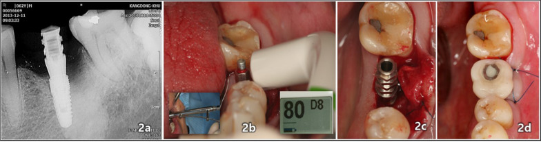 An eight-year retrospective study on the clinical outcomes of laser surface-treated implants.
