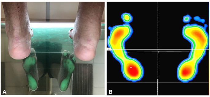 Good Short- and Mid-term Outcome After Cross-Linked Hyaluronic Acid Infiltration for Hallux Rigidus: A Case Report.