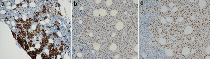Breast Cancer With Release of Tumor Cells in Peripheral Blood Mimicking Acute Myeloid Leukemia.