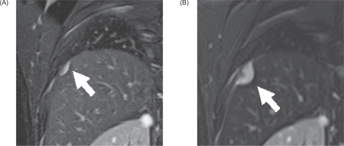 Clinical T1a Renal Cell Carcinoma with Solitary Diaphragmatic Metastasis in a Patient with von Hippel-Lindau Disease.