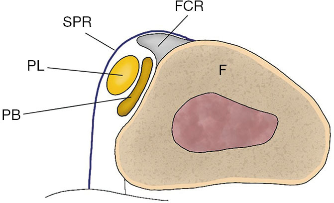 Recurrent peroneal tendon dislocation-the current concept of management.