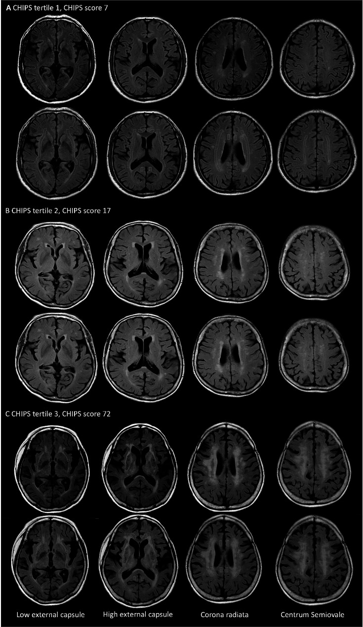 Effects of strategic white matter hyperintensities of cholinergic pathways on basal forebrain volume in patients with amyloid-negative neurocognitive disorders.