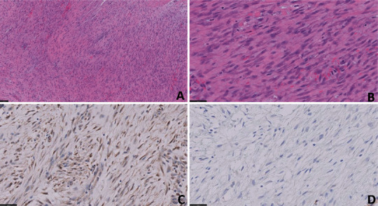 First Description of the Clinical Activity of Avapritinib in Sporadic Mesenteric Desmoid Tumor.