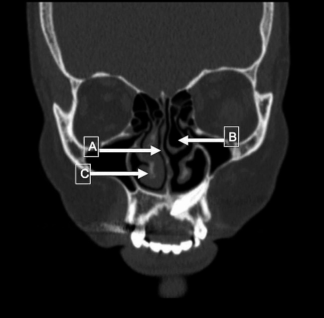 Role of paranasal abnormalities and systemic inflammation on primary acquired nasolacrimal duct obstruction.