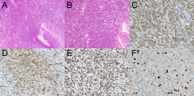Non-islet cell tumor hypoglycemia that required immediate surgery after a long-term asymptomatic state: recommendation for early intervention.
