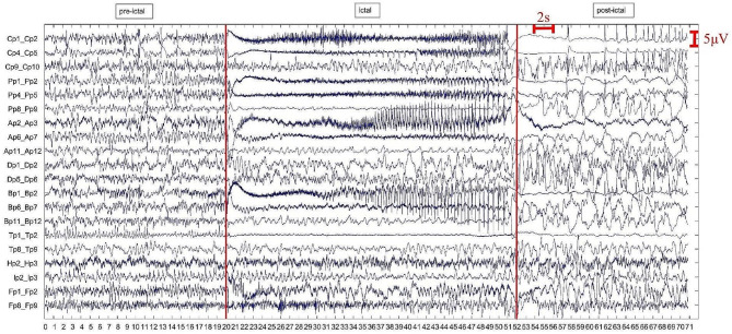 Ictal-onset localization through effective connectivity analysis based on RNN-GC with intracranial EEG signals in patients with epilepsy.