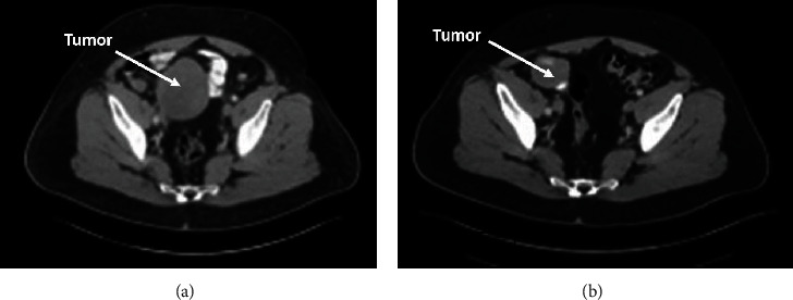 First Description of the Clinical Activity of Avapritinib in Sporadic Mesenteric Desmoid Tumor.