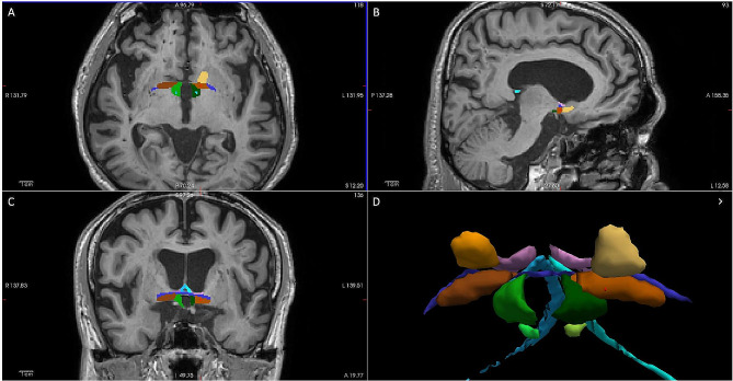 Effects of strategic white matter hyperintensities of cholinergic pathways on basal forebrain volume in patients with amyloid-negative neurocognitive disorders.