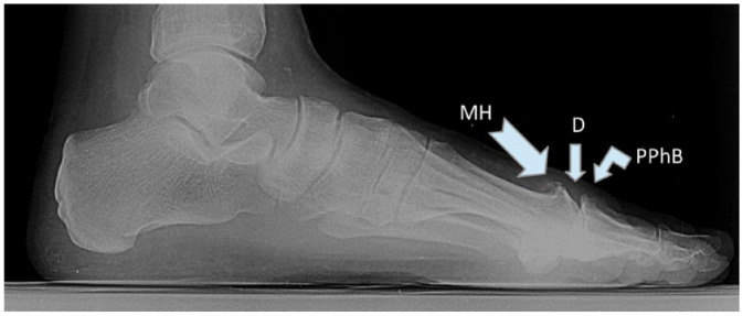 Good Short- and Mid-term Outcome After Cross-Linked Hyaluronic Acid Infiltration for Hallux Rigidus: A Case Report.