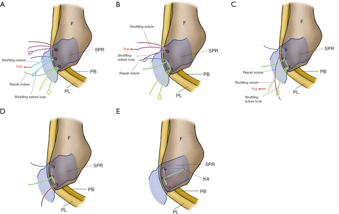 Recurrent peroneal tendon dislocation-the current concept of management.