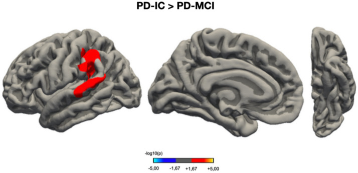 Mapping brain morphology to cognitive deficits: a study on PD-CRS scores in Parkinson's disease with mild cognitive impairment.