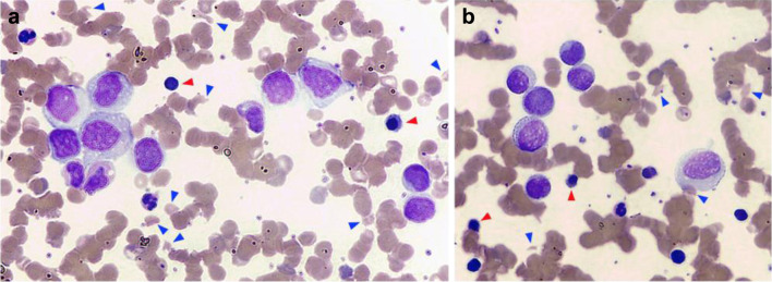Breast Cancer With Release of Tumor Cells in Peripheral Blood Mimicking Acute Myeloid Leukemia.