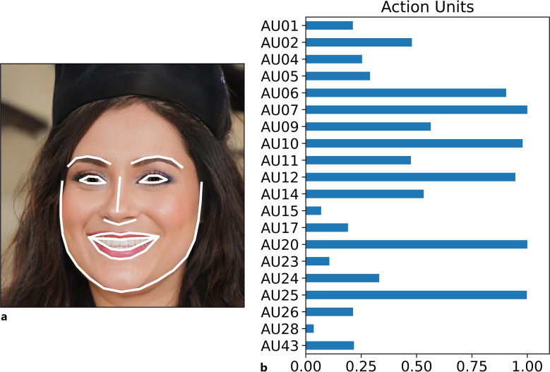 Video Assessment to Detect Amyotrophic Lateral Sclerosis.