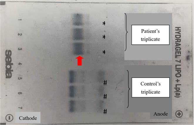 A novel splicing variant in ABCA1 in the first reported Hong Kong Chinese patient with high-density lipoprotein deficiency.