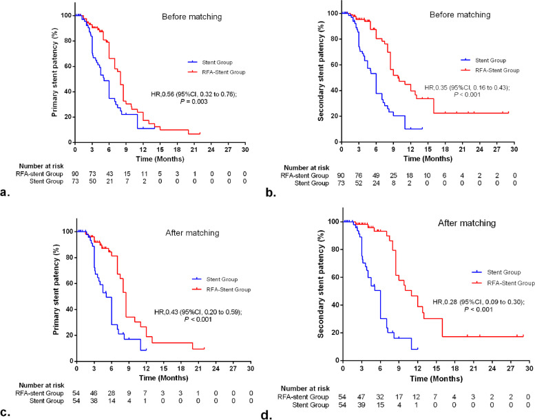 Percutaneous endobiliary radiofrequency ablation and stent placement for unresectable malignant biliary obstruction: a propensity score matching retrospective study.