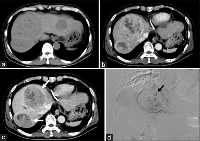 Tumor diameter and enhancing capsule, as well as previous interventional treatments, as potential predictors of vascular lake phenomenon in hepatocellular carcinoma patients treated with drug-eluting beads transarterial chemoembolization.