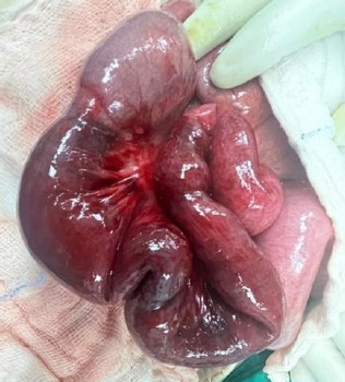 A rare convergence: Gangrenous bowel secondary to closed-loop obstruction with elevated urine amylase levels - A comprehensive case report.