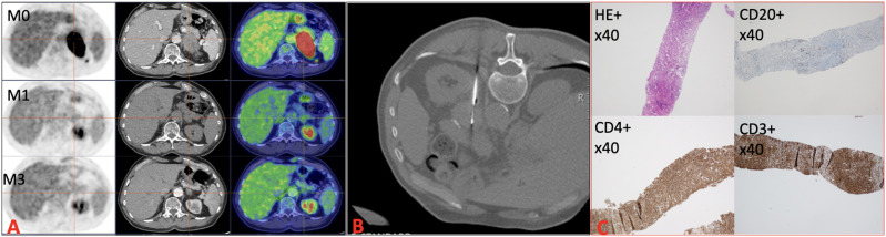 To biopsy or not to biopsy adrenal mass: is that the question?