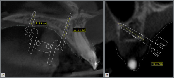 Miniscrew-assisted rapid palatal expansion (MARPE): Factors influencing planning.