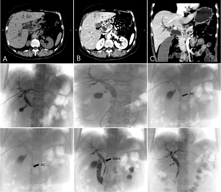 Percutaneous endobiliary radiofrequency ablation and stent placement for unresectable malignant biliary obstruction: a propensity score matching retrospective study.