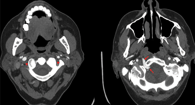 Persistent Hypoglossal Artery.