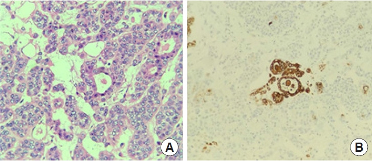 Successful surgical interventions for a giant and complicated myoepithelial carcinoma: a case report.