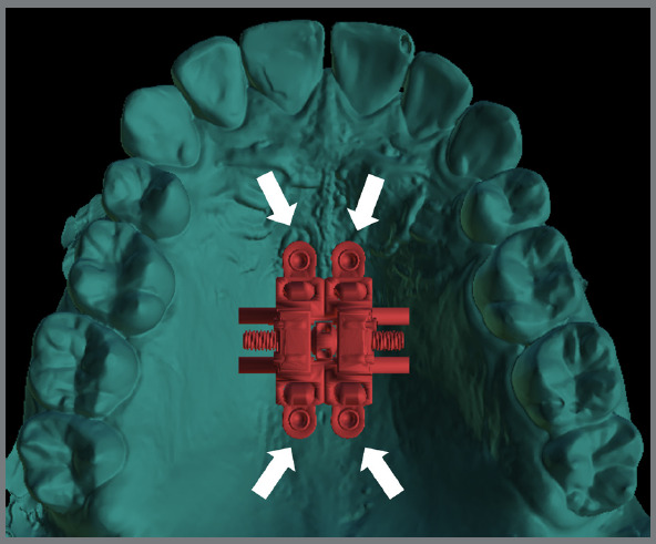 Miniscrew-assisted rapid palatal expansion (MARPE): Factors influencing planning.