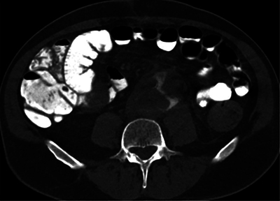 Aortoenteric Fistula with Digestive Contrast Material Leaking in the Aneurysmal Sac.