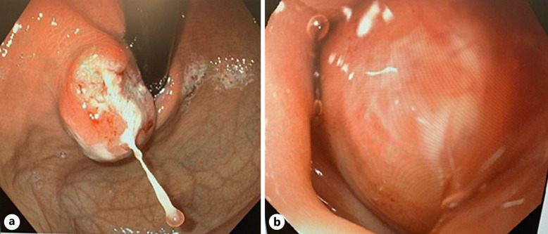 Esophageal Tuberculosis as a Rare Cause of Dysphagia: Case Report.