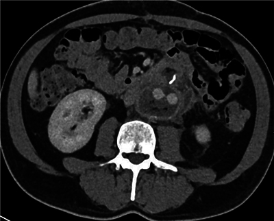Aortoenteric Fistula with Digestive Contrast Material Leaking in the Aneurysmal Sac.