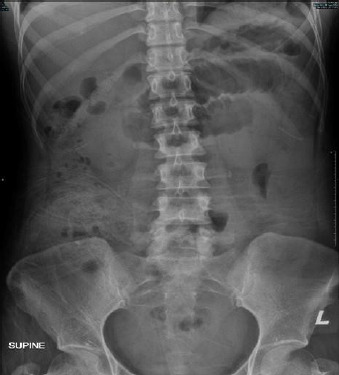 A rare convergence: Gangrenous bowel secondary to closed-loop obstruction with elevated urine amylase levels - A comprehensive case report.