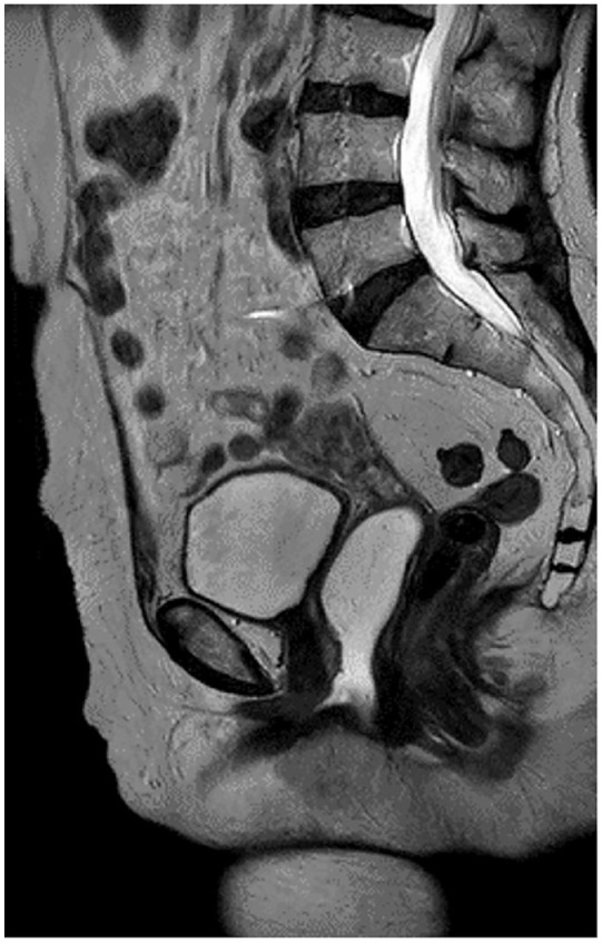 Urethral Calculus as an Uncommon Cause of Acute Urinary Retention in Women Diagnosis and Management: A Case Report.