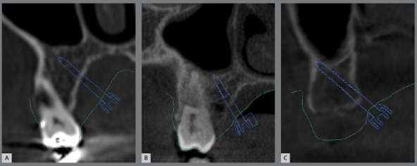 Miniscrew-assisted rapid palatal expansion (MARPE): Factors influencing planning.