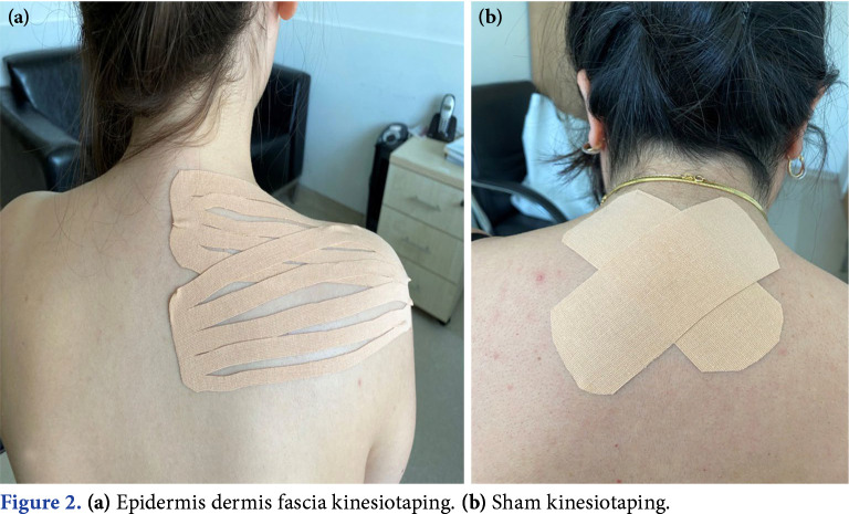 Short-term effectiveness of epidermis dermis fascia kinesiotaping technique in myofascial pain syndrome on upper trapezius: A multi-center, double-blind, randomized clinical study.