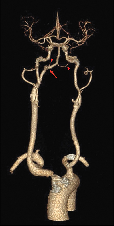 Persistent Hypoglossal Artery.