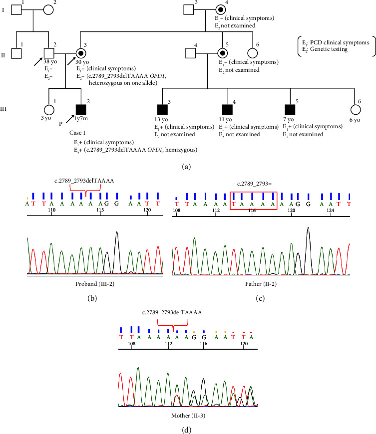 Two Pediatric Cases of Primary Ciliary Dyskinesia Caused by Loss-of-Function Variants in Oral-Facial-Digital Syndrome Gene, <i>OFD1</i>.