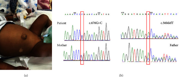 Expanding the Phenotype of Congenital Glucocorticoid Deficiency: An Iranian Patient with Cholestasis due to Pathogenic Variants in the <i>MC2R</i> Gene.
