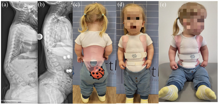 Achondroplasia current concept of orthopaedic management.