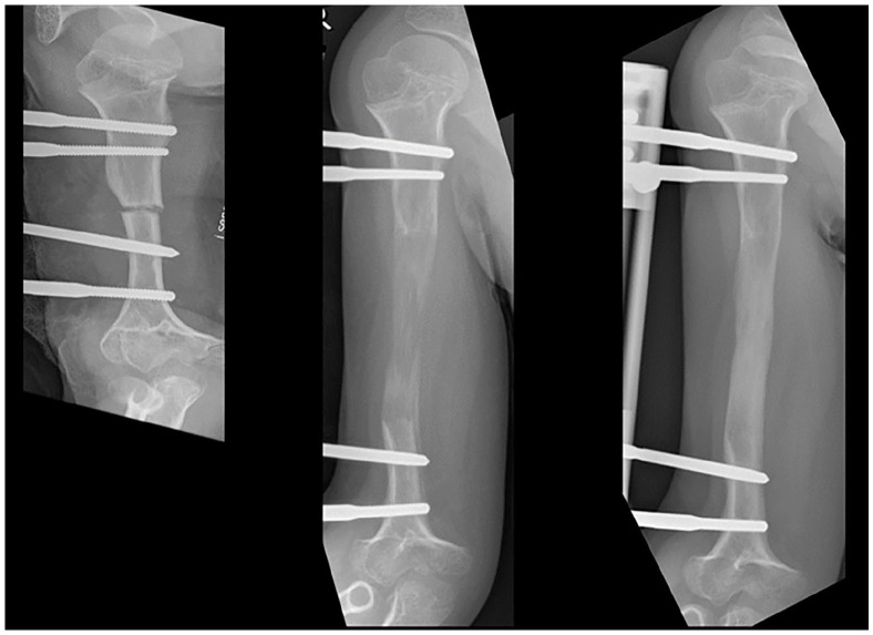 Achondroplasia current concept of orthopaedic management.