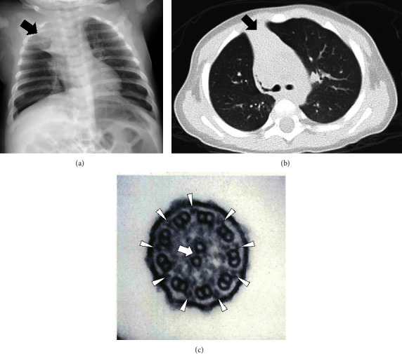 Two Pediatric Cases of Primary Ciliary Dyskinesia Caused by Loss-of-Function Variants in Oral-Facial-Digital Syndrome Gene, <i>OFD1</i>.