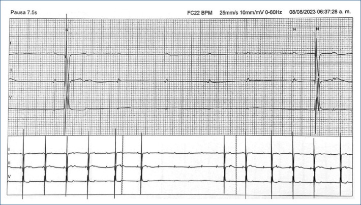[Late onset complete atrioventricular block following surgical closure of atrioventricular defect: case report].